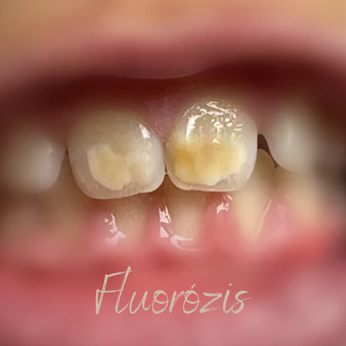 A fluorid valós szerepe és veszélyei a szájápolásban